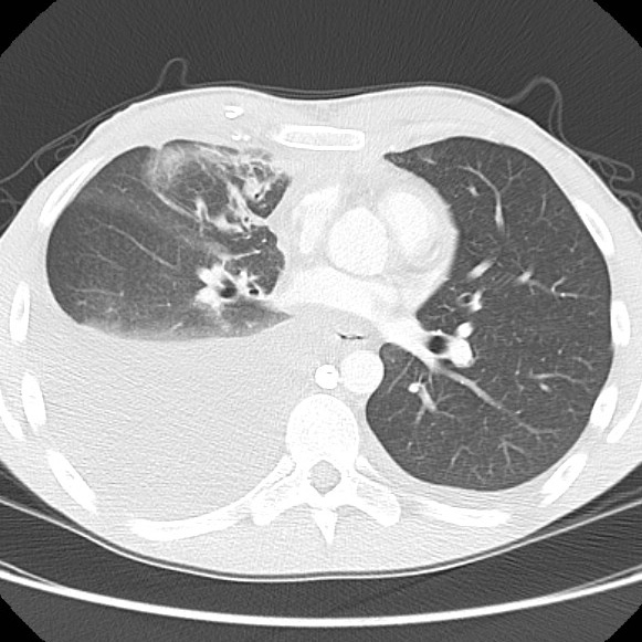 File:Non-Hodgkin lymphoma involving lung (Radiopaedia 29094-29470 Axial lung window 38).jpg