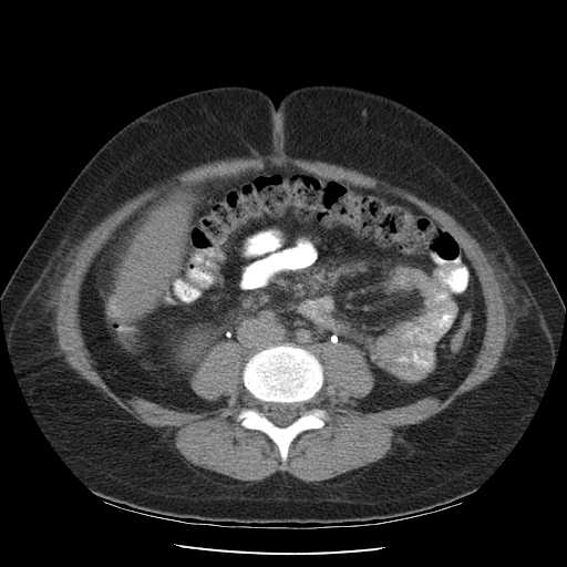 File:Non-Hodgkin lymphoma involving pelvis (Radiopaedia 21281-21197 B 39).jpg