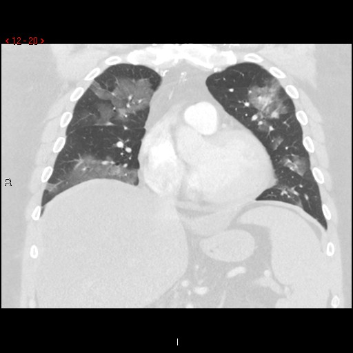 File:Non-specific interstitial pneumonitis (Radiopaedia 27044-27222 Coronal lung window 20).jpg