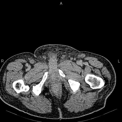 Non Hodgkin lymphoma in a patient with ankylosing spondylitis (Radiopaedia 84323-99621 Axial C+ delayed 91).jpg