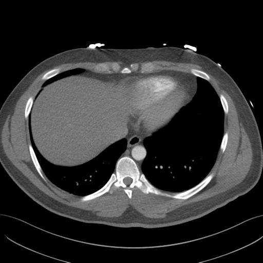 File:Normal CTA thorax (non ECG gated) (Radiopaedia 41750-44704 A 73).png