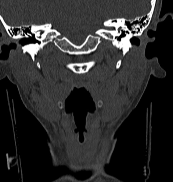 File:Normal CT cervical spine - 12-year-old (Radiopaedia 55352-61775 Coronal bone window 26).jpg