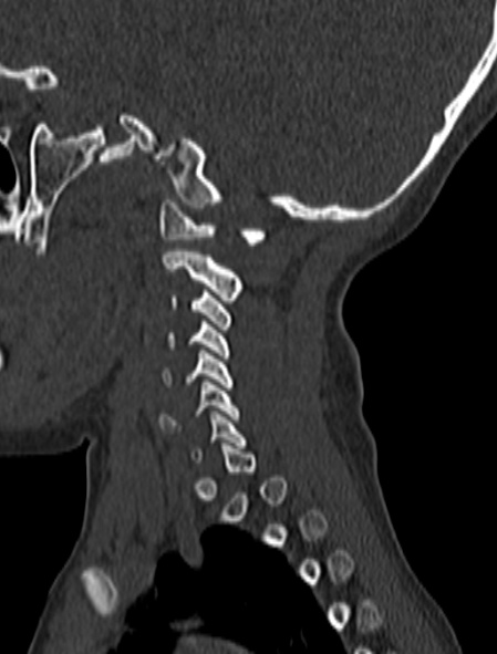Normal CT cervical spine - pediatric (Radiopaedia 52549-58462 Sagittal bone window 167).jpg