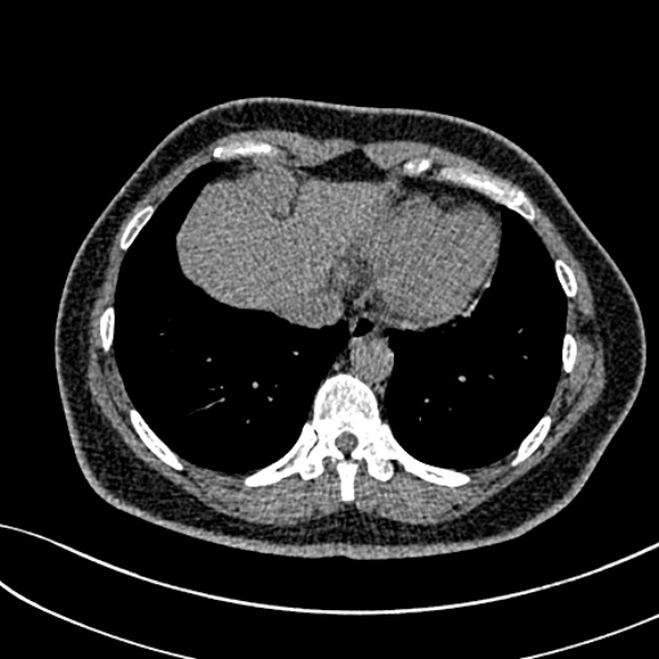 Normal CT chest- adult female (Radiopaedia 52522-58428 Axial non-contrast 98).jpg