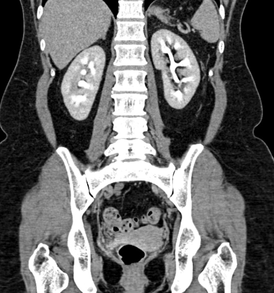 Normal CT intravenous urogram (Radiopaedia 39444-41759 A 312).jpg