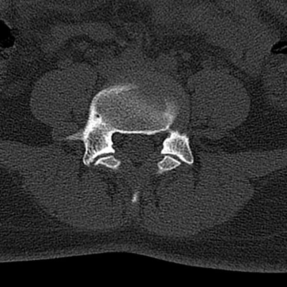 File:Normal CT lumbar spine (Radiopaedia 53981-60118 Axial bone window 54).jpg