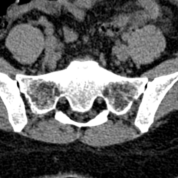 Normal CT lumbar spine (Radiopaedia 53981-60118 Axial non-contrast 94).jpg