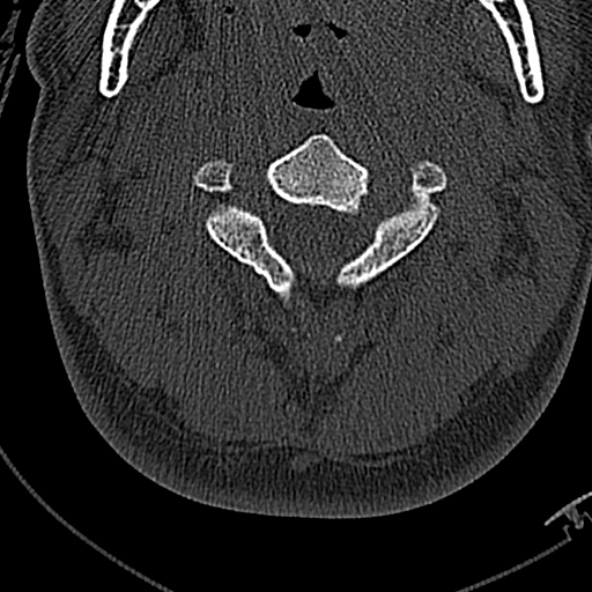 File:Normal CT of the cervical spine (Radiopaedia 53322-59305 Axial bone window 92).jpg