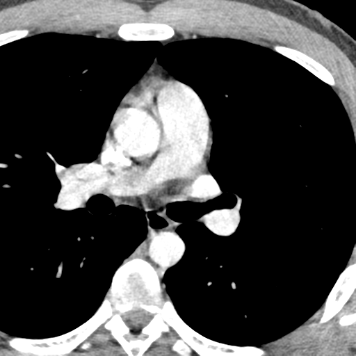 File:Normal CT pulmonary veins (pre RF ablation) (Radiopaedia 41748-44702 A 91).png