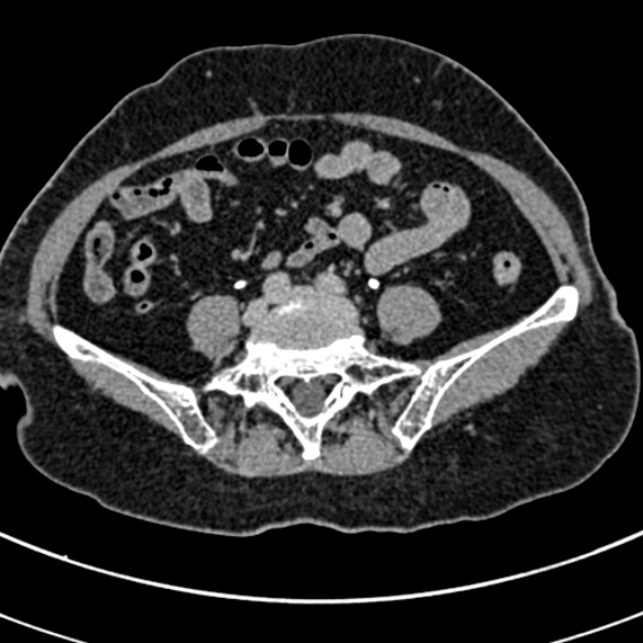 File:Normal CT split bolus study of the renal tract (Radiopaedia 48631-53634 Axial split bolus 190).jpg
