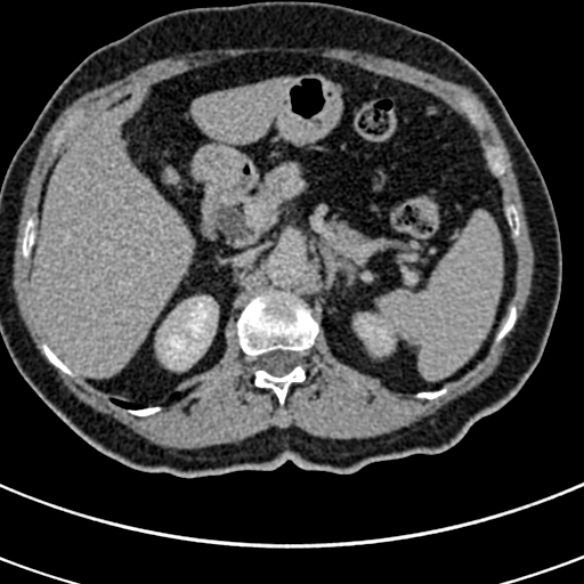 File:Normal CT split bolus study of the renal tract (Radiopaedia 48631-53634 Axial split bolus 31).jpg