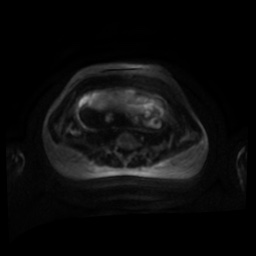 Normal MRI abdomen in pregnancy (Radiopaedia 88001-104541 Axial DWI 102).jpg