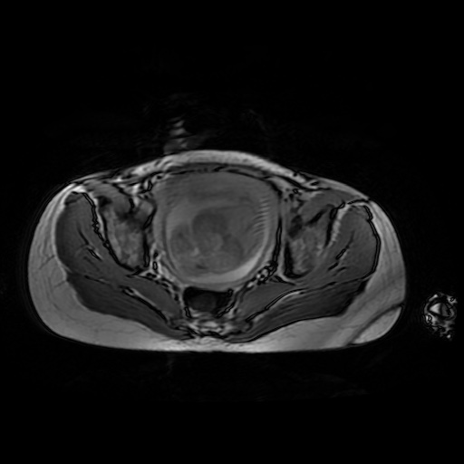 File:Normal MRI abdomen in pregnancy (Radiopaedia 88001-104541 Axial Gradient Echo 48).jpg