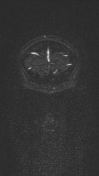 Normal MRI brain with MRV- teenager (Radiopaedia 49425-54553 Coronal MRV 40).jpg