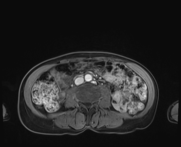 Normal adrenal glands MRI (Radiopaedia 82017-96004 K 59).jpg