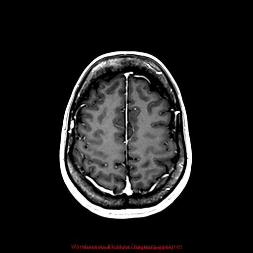 Normal adult brain MRI (non-enhanced and contrast-enhanced) (Radiopaedia 75262-86379 Axial T1 C+ 144).jpg