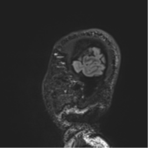 Normal brain MRI (non-focal epilepsy protocol) (Radiopaedia 53917-60040 Sagittal DIR 57).png