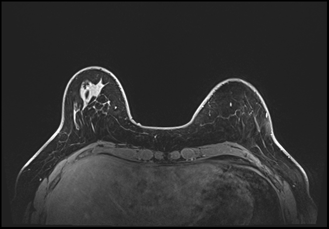 Normal breast MRI - dense breasts (Radiopaedia 80454-93850 C 49).jpg