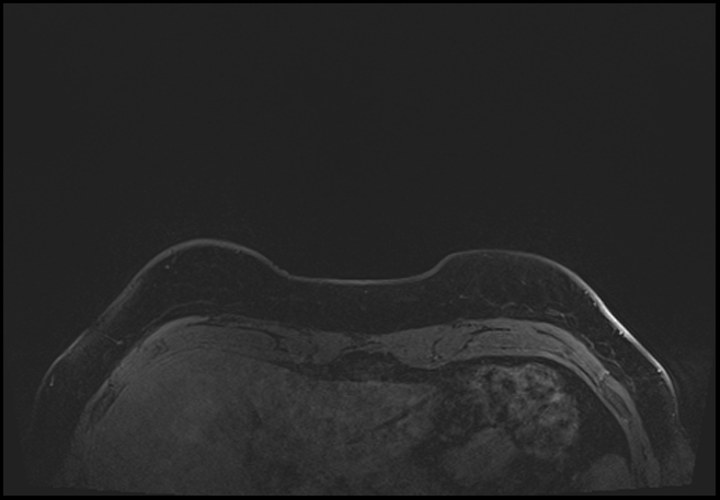 Normal breast MRI - dense breasts (Radiopaedia 80454-93850 C 8).jpg