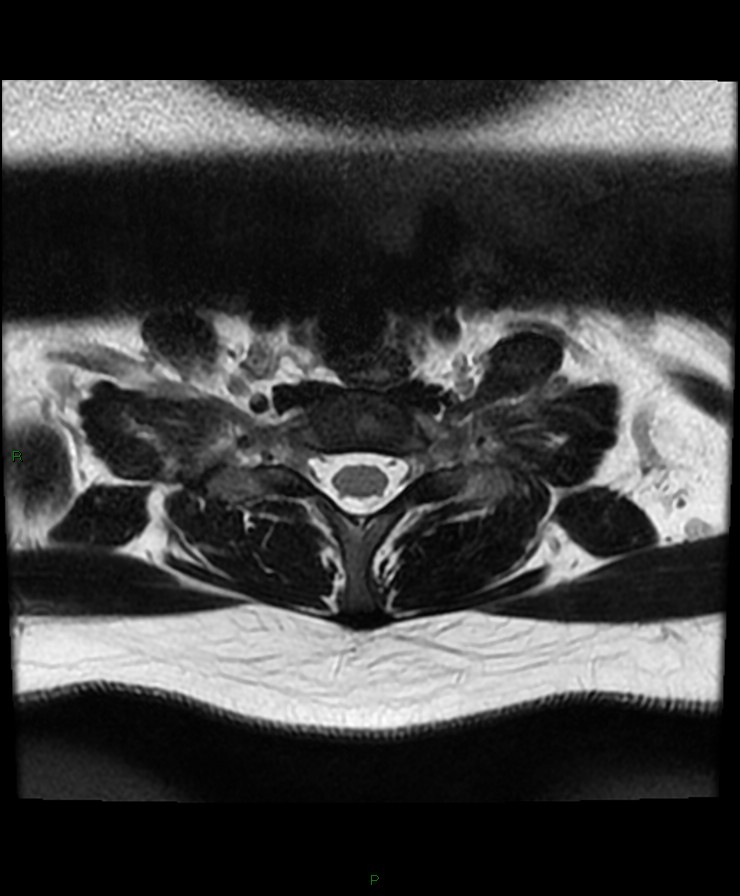 Normal cervical spine MRI (Radiopaedia 80146-93454 Axial T2 89).jpg