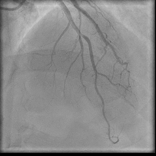 Normal coronary angiogram (DSA) (Radiopaedia 63081-71571 E 57).jpg