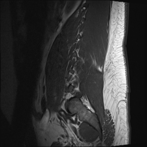 File:Normal lumbar spine MRI (Radiopaedia 47857-52609 Sagittal T1 1).jpg
