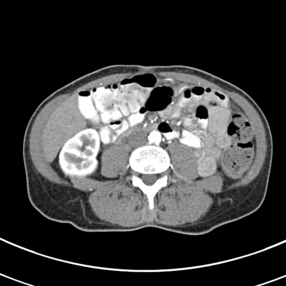 File:Normal multiphase CT liver (Radiopaedia 38026-39996 B 50).jpg