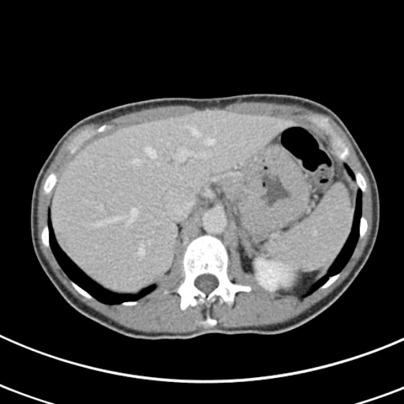 File:Normal multiphase CT liver (Radiopaedia 38026-39996 C 16).jpg