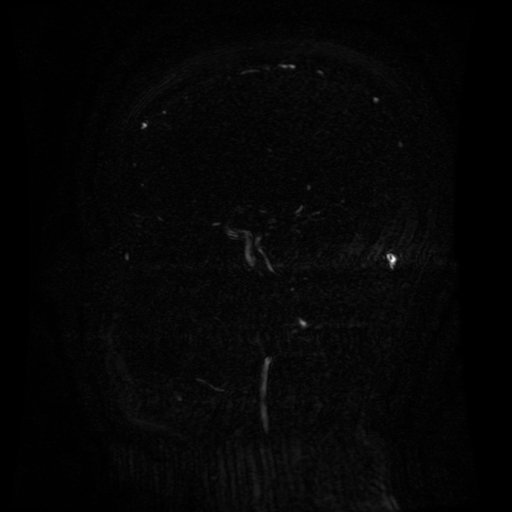 Normal noncontrast MR venography (Radiopaedia 87578-103957 A 103).jpg