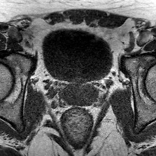 File:Normal prostate (MRI) (Radiopaedia 29986-30535 Axial T1 14).jpg