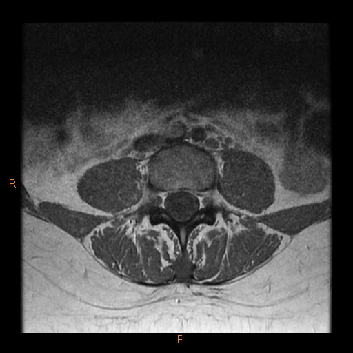 File:Normal spine MRI (Radiopaedia 77323-89408 Axial T1 12).jpg