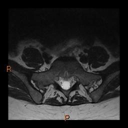 File:Normal spine MRI (Radiopaedia 77323-89408 Axial T2 26).jpg