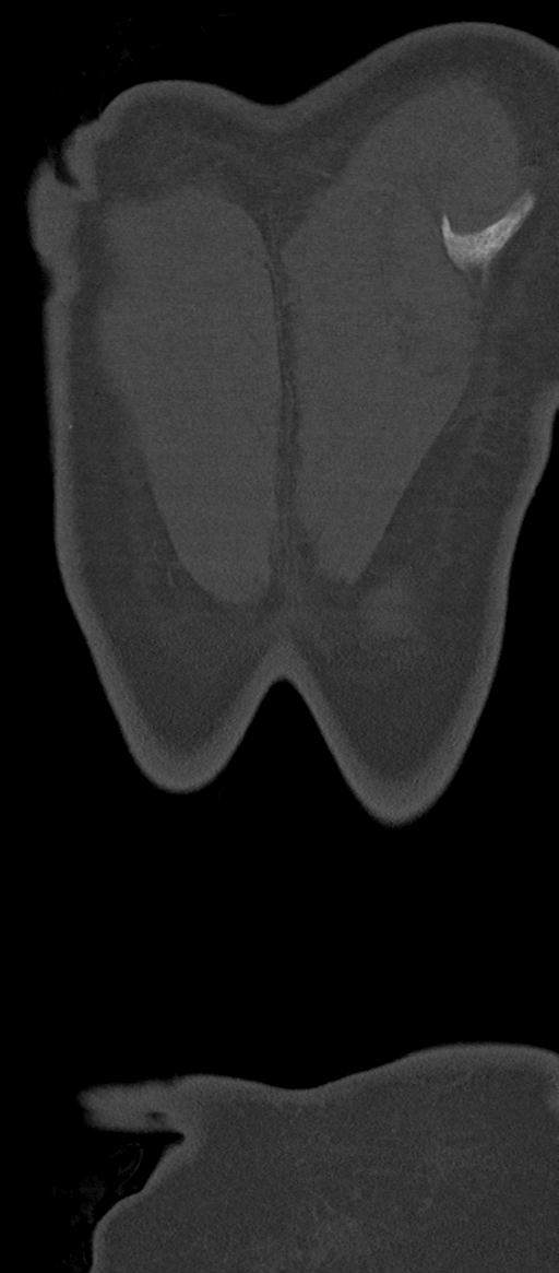 Normal thoracolumbar spine (Radiopaedia 43822-47309 Coronal bone window 94).png