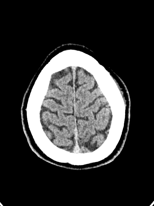 Normal trauma protocol brain and C-spine CT (Radiopaedia 83302-97709 Axial non-contrast 16).jpg