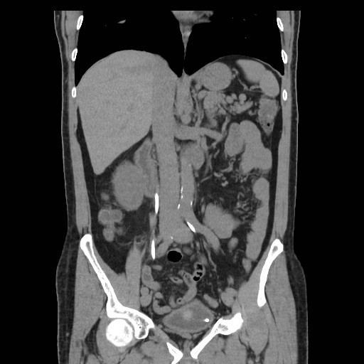 File:Obstructed kidney with perinephric urinoma (Radiopaedia 26889-27067 Coronal non-contrast 5).jpg