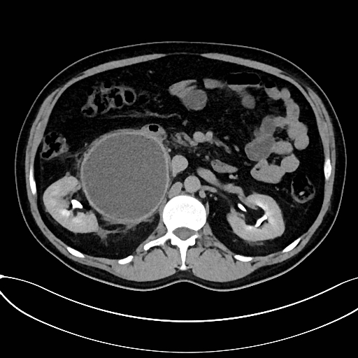 Obstructed upper pole ureter in a duplex kidney (Radiopaedia 54935-61221 Axial C+ delayed 19).jpg
