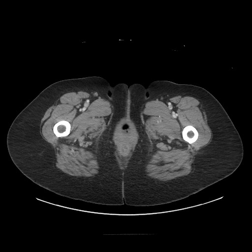 Obstructive distal colonic adenocarcinoma causing cecal perforation (Radiopaedia 86830-102989 A 212).jpg