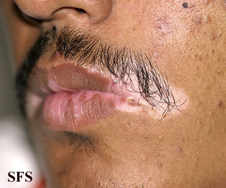 File:Vitiligo (Dermatology Atlas 31).jpg