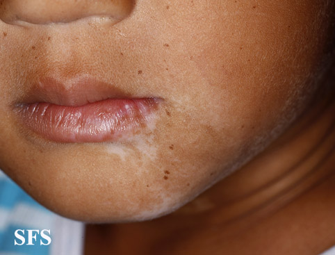 File:Vitiligo (Dermatology Atlas 42).jpg