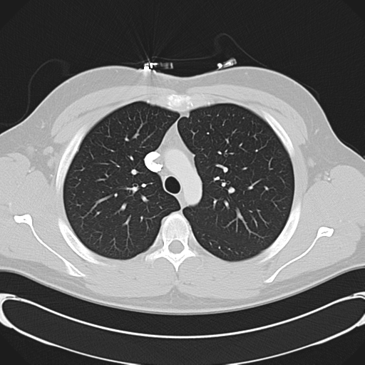 'Bovine' aortic arch (Radiopaedia 33554-34637 Axial lung window 19).png