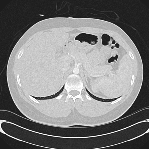 File:'Bovine' aortic arch (Radiopaedia 33554-34637 Axial lung window 65).png