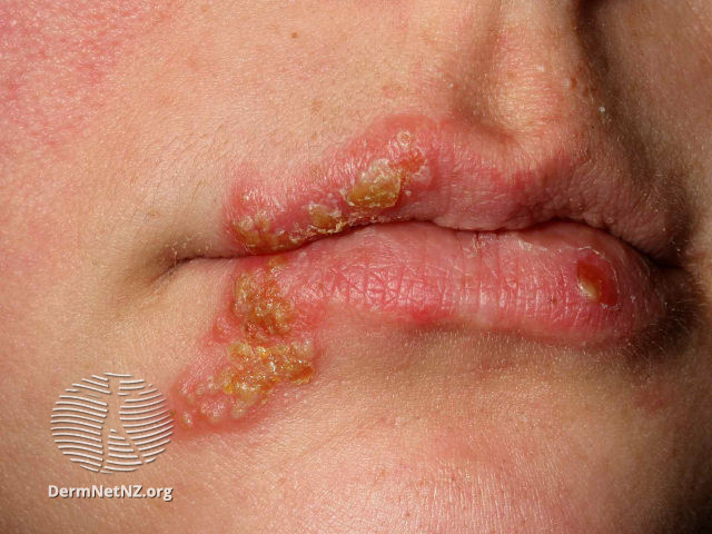 (DermNet NZ herpes-simplex-labialis-36).jpg