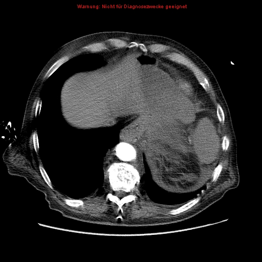 Abdominal aortic aneurysm- extremely large, ruptured (Radiopaedia 19882-19921 Axial C+ arterial phase 8).jpg