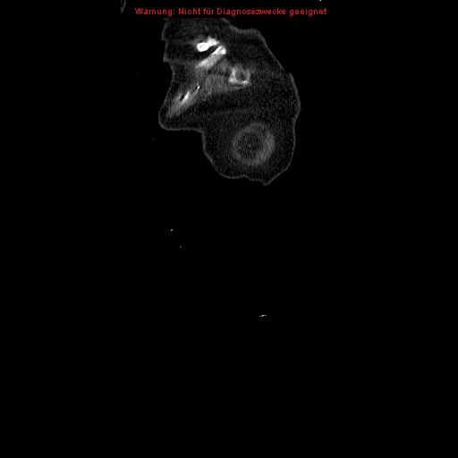 Abdominal aortic aneurysm- extremely large, ruptured (Radiopaedia 19882-19921 Coronal C+ arterial phase 2).jpg