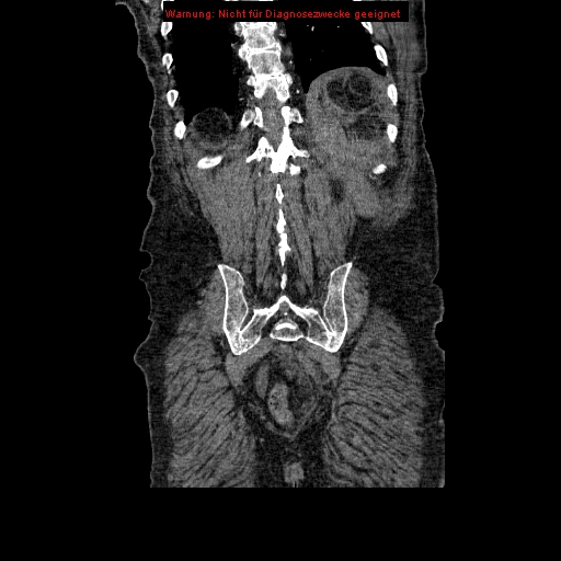 Abdominal aortic aneurysm- extremely large, ruptured (Radiopaedia 19882-19921 Coronal C+ arterial phase 88).jpg