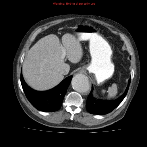 Abdominal aortic aneurysm (Radiopaedia 10122-10660 Axial C+ portal venous phase 13).jpg