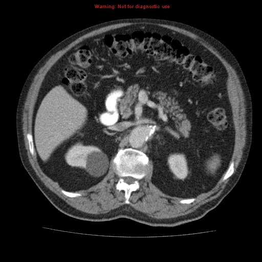 Abdominal aortic aneurysm (Radiopaedia 10122-10660 Axial C+ portal venous phase 25).jpg