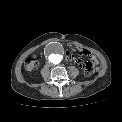 Abdominal aortic aneurysm (Radiopaedia 13341-13340 Axial C+ arterial phase 127).jpg