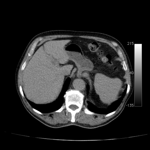 Abdominal aortic aneurysm (Radiopaedia 29248-29660 Axial non-contrast 14).jpg
