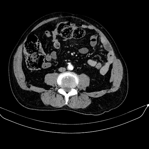 Abdominal aortic aneurysm (Radiopaedia 67117-76452 Axial C+ arterial phase 81).jpg